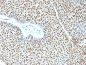 IHC testing of FFPE human cervical tumor with phospho-c-Jun antibody (clone C-J 4C4/1). HIER: boil tissue sections in pH6, 10mM citrate buffer, for 10-20 min followed by cooling at RT for 20 min.