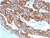 IHC staining of FFPE human colon carinoma with recombinant CK18 antibody (clone KRT18/2808R). Required HIER: boil tissue sections in pH 9 10mM Tris with 1mM EDTA for 10-20 min and allow to cool before testing.
