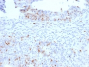 IHC staining of FFPE human colon carcinoma with RAD51 antibody (clone RAD51/2701). HIER: boil tissue sections in pH 9 10mM Tris with 1mM EDTA for 10-20 min and allow to cool before testing.