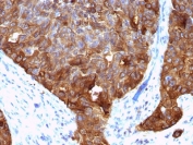 IHC testing of FFPE human colon carcinoma with MUC1 antibody (clone VU-4H5). HIER: requires steaming of sections in pH 9 10mM Tris with 1mM EDTA for 10-20 min and allow to cool before testing.