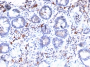 IHC staining of FFPE human gastric carcinoma with MUC3 antibody (clone MUC3/1154). HIER: boil tissue sections in 10mM Tris with 1mM EDTA, pH 9, for 10-20 min and allow to cool before testing.