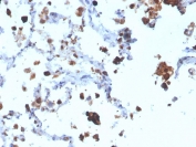 IHC staining of FFPE human lung adenocarcinoma with Napsin A antibody (clone NAPSA/3308). HIER: boil sections in pH 9 10mM Tris with 1mM EDTA for 10-20 minutes, followed by cooling at RT for 20 minutes, prior to staining.