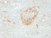IHC staining of FFPE human neuroendocrine tumor with NSE antibody. HIER: boil tissue sections in pH 9 10mM Tris with 1mM EDTA for 10-20 min and allow to cool before testing.