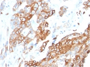 IHC staining of FFPE human breast carcinoma with Neuregulin-1 antibody (clone NRG1/2710). HIER: boil tissue sections in pH 9 10mM Tris with 1mM EDTA for 10-20 min and allow to cool before testing.