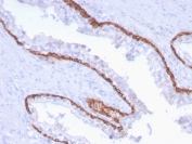 IHC staining of FFPE human prostate carcinoma with CK15 antibody (clone KRT15/2959). HIER: boil tissue sections in pH 9 10mM Tris with 1mM EDTA for 10-20 min and allow to cool before testing.