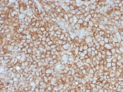 IHC staining of FFPE human melanoma with MCAM antibody (clone MCAM/3046). HIER: boil tissue sections in pH 9 10mM Tris with 1mM EDTA for 20 min and allow to cool before testing.