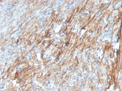 IHC staining of FFPE human prostate carcinoma with Fibronectin antibody (clone FN1/3029). HIER: boil tissue sections in pH 9 10mM Tris with 1mM EDTA for 20 min and allow to cool before testing.