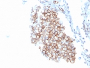 IHC staining of FFPE human lung carcinoma with CD86 antibody (clone C86/3716). HIER: boil tissue sections in pH 9 10mM Tris with 1mM EDTA for 20 min and allow to cool before testing.