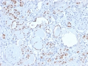 IHC staining of FFPE human kidney with recombinant PAX8 antibody. HIER: boil tissue sections in pH 9 10mM Tris with 1mM EDTA for 20 min and allow to cool before testing.