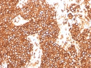 IHC staining of FFPE human Ewings sarcoma with recombinant CD99 antibody (clone MIC2/3478R). HIER: boil tissue sections in pH 9 10mM Tris with 1mM EDTA for 20 min and allow to cool before testing.