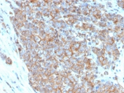 IHC staining of FFPE human urothelial carcinoma with CD33 antibody (clone SIGLEC3/3600). HIER: boil tissue sections in pH 9 10mM Tris with 1mM EDTA for 20 min and allow to cool before testing.