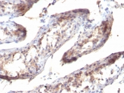 IHC staining of FFPE human testicular carcinoma with TGF-a antibody (clone SPM357). HIER: pH 9 10mM Tris with 1mM EDTA.