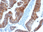 IHC staining of FFPE human colon tissue with recombinant Delta 1 Catenin antibody (clone CTNND1/4383R) at 2ug/ml in PBS for 30min RT. HIER: boil tissue sections in pH 9 10mM Tris with 1mM EDTA for 20 min and allow to cool before testing.