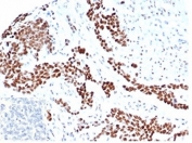 IHC staining of FFPE human ovarian carcinoma tissue with recombinant WT1 antibody (clone rWT1/6908). Negative control inset: PBS instead of primary antibody to control for secondary binding. HIER: boil tissue sections in pH 9 10mM Tris with 1mM EDTA for 20 min and allow to cool before testing.