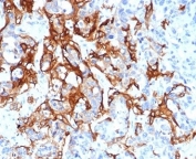 IHC staining of FFPE human colorectal liver metastasis with recombinant TROP2 antibody (clone TACSTD2/6396R). HIER: boil tissue sections in pH 9 10mM Tris with 1mM EDTA for 20 min and allow to cool before testing.