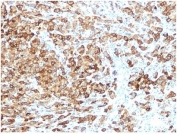 IHC staining of FFPE human melanoma tissue with recombinant PMEL17 antibody (clone rPMEL17/6821). HIER: boil tissue sections in pH 9 10mM Tris with 1mM EDTA for 20 min and allow to cool before testing.