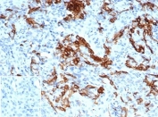 IHC staining of FFPE human melanoma tissue with NGFR/TNFRSF16antibody (clone NGFR/4919) at 2ug/ml. Negative control inset: PBS used instead of primary antibody to control for secondary Ab binding. HIER: boil tissue sections in pH 9 10mM Tris with 1mM EDTA for 20 min and allow to cool before testing.