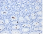 IHC staining of FFPE human H. pylori-infected stomach tissue with Helicobacter pylori Catalase antibody (clone HPYL/7171). HIER: boil tissue sections in pH 9 10mM Tris with 1mM EDTA for 20 min and allow to cool before testing.