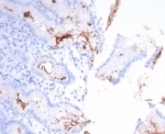IHC staining of H. pylori-infected FFPE human stomach tissue with Helicobacter pylori antibody (clone HPYL/7226). HIER: boil tissue sections in pH 9 10mM Tris with 1mM EDTA for 20 min and allow to cool before testing.