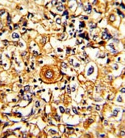 IHC testing of FFPE human breast carcinoma tissue with PTAR1 antibody. HIER: steam section in pH6 citrate buffer for 20 min and allow to cool prior to staining.