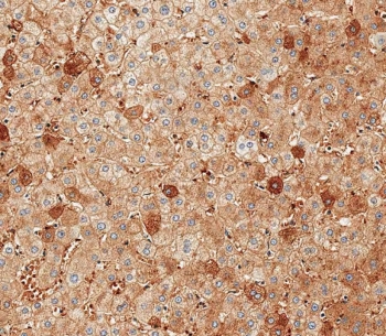 Albumin Antibody Human Liver Tissue IHC. Immunohistochemistry staining testing of FFPE human liver tissue with Albumin antibody. HIER: steam section in pH9 EDTA for 20 min and allow to cool prior to staining.