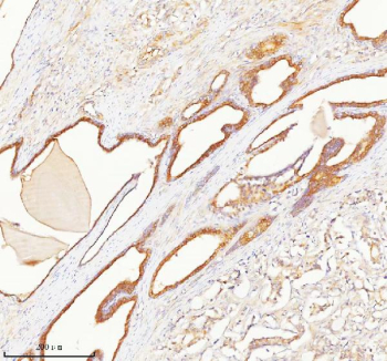 Immunohistochemical staining of TNIK using anti-TNIK antibody. TNIK was detected in a paraffin-embedded section of human prostate adenocarcinoma tissue. Heat mediated antigen retrieval was performed in EDTA buffer (pH 8.0, epitope retrieval solution). The tissue section was blocked with 10% goat serum. The tissue section was then incubated with 2 ug/ml rabbit anti-TNIK antibody overnight at 4oC. Peroxidase Conjugated Goat Anti-rabbit IgG was used as secondary antibody and incubated for 30 minutes at 37oC. The tissue section was developed using an HRP secondary and DAB substrate.