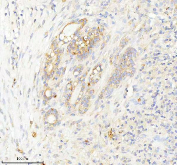 Immunohistochemical staining of INTS4 using anti-INTS4 antibody. INTS4 was detected in a paraffin-embedded section of human thyroid cancer tissue. Heat mediated antigen retrieval was performed in EDTA buffer (pH 8.0, epitope retrieval solution). The tissue section was blocked with 10% goat serum. The tissue section was then incubated with 2 ug/ml rabbit anti-INTS4 antibody overnight at 4oC. Peroxidase Conjugated Goat Anti-rabbit IgG was used as secondary antibody and incubated for 30 minutes at 37oC. The tissue section was developed using an HRP secondary and DAB substrate.