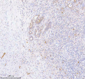 Immunohistochemical staining of INTS4 using anti-INTS4 antibody. INTS4 was detected in a paraffin-embedded section of human thyroid cancer tissue. Heat mediated antigen retrieval was performed in EDTA buffer (pH 8.0, epitope retrieval solution). The tissue section was blocked with 10% goat serum. The tissue section was then incubated with 2 ug/ml rabbit anti-INTS4 antibody overnight at 4oC. Peroxidase Conjugated Goat Anti-rabbit IgG was used as secondary antibody and incubated for 30 minutes at 37oC. The tissue section was developed using an HRP secondary and DAB substrate.