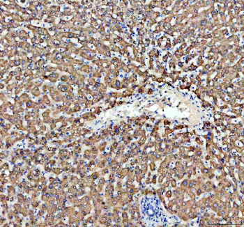 Immunohistochemical staining of FFPE human liver cancer tissue with ACOX1 antibody, HRP-secondary and DAB substrate. HIER: boil tissue sections in pH8 EDTA for 20 min and allow to cool before testing.