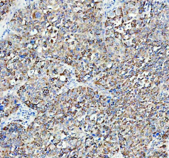 Immunohistochemical staining of FFPE human liver cancer tissue with ACOX1 antibody, HRP-secondary and DAB substrate. HIER: boil tissue sections in pH8 EDTA for 20 min and allow to cool before testing.