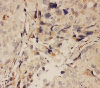 IHC testing of FFPE human breast cancer tissue with RANK antibody at 1ug/ml. Required HIER: steam section in pH6 citrate buffer for 20 min and allow to cool prior to tetsting.
