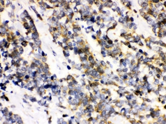 IHC testing of FFPE human lung cancer with ATXN3 antibody. HIER: Boil the paraffin sections in pH 6, 10mM citrate buffer for 20 minutes and allow to cool prior to staining.