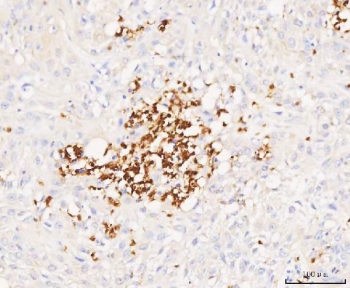 IHC staining of FFPE human bladder urothelial carcinoma tissue with Grancalcin antibody. HIER: boil tissue sections in pH8 EDTA for 20 min and allow to cool before testing.