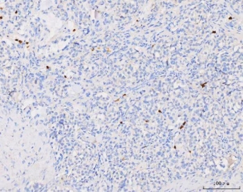 IHC staining of FFPE human lung cancer tissue with Grancalcin antibody. HIER: boil tissue sections in pH8 EDTA for 20 min and allow to cool before testing.