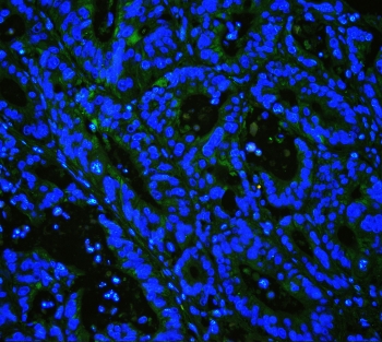 IHC staining of FFPE human intestinal cancer with Caveolin-3 antibody at 1ug/ml (green) and DAPI nuclear stain (blue). HIER: boil tissue sections in pH6, 10mM citrate buffer, for 10-20 min and allow to cool before testing.