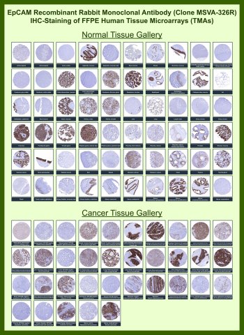 EpCAM Antibody for IHC Tissue Microarray (TMA). Immunohistochemistry analysis of Epithelial cell adhesion molecule EPCAM, also known as CD326, in formalin-fixed paraffin-embedded human normal and cancer tissue microarrays using recombinant rabbit monoclonal EpCAM antibody clone MSVA-326R. Tissue microarray (TMA) staining with HRP-DAB brown chromogen demonstrates strong membranous localization in epithelial structures, including colon mucosa, small intestine, stomach, prostate, and endometrial glands, while non-epithelial tissues such as skeletal muscle, lymphoid tissues, and stromal compartments show minimal to absent staining. Within tumor tissue microarrays, robust membranous positivity is observed across multiple epithelial malignancies including colorectal adenocarcinoma, breast carcinoma, lung adenocarcinoma, ovarian carcinoma, pancreatic carcinoma, and urothelial carcinoma, while mesenchymal tumors and non-epithelial malignancies remain largely negative. Evaluation across large TMA panels enables direct comparison of EPCAM expression across diverse tissue types under standardized conditions. The observed staining patterns align with reported EPCAM expression profiles in the Human Protein Atlas and support its use in identifying epithelial-derived tumor cells.