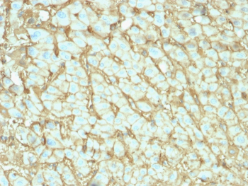 Albumin Antibody Human Hepatocellular Carcinoma Tissue IHC. Immunohistochemistry testing of FFPE human hepatocellular carcinoma with microarray validated Albumin antibody (clone ALB/2142). Required HIER: boil tissue sections in 10mM citrate buffer, pH6, for 10-20 min followed by cooling at RT for 20 min.