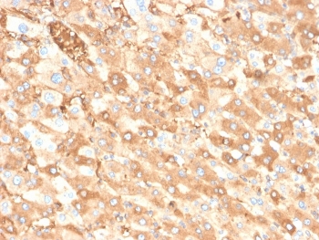 Albumin Antibody Liver Carcinoma IHC. Immunohistochemistry staining of FFPE human liver carcinoma in colon tissue with recombinant Albumin antibody (clone ALB/6413R). HIER: boil tissue sections in pH 9 10mM Tris with 1mM EDTA for 20 min and allow to cool before testing.
