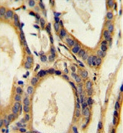 CCL4 antibody immunohistochemistry analysis in formalin fixed and paraffin embedded human prostate carcinoma.