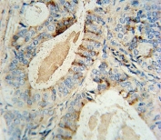 GCNT2 antibody immunohistochemistry analysis in formalin fixed and paraffin embedded human prostate carcinoma.