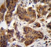 ZGRF1 antibody immunohistochemistry analysis in formalin fixed and paraffin embedded human bladder carcinoma.