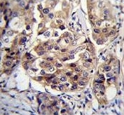 hCG1995004 antibody immunohistochemistry analysis in formalin fixed and paraffin embedded human breast carcinoma.