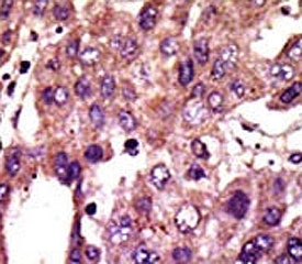 IHC analysis of FFPE human hepatocarcinoma stained with the AMFR antibod