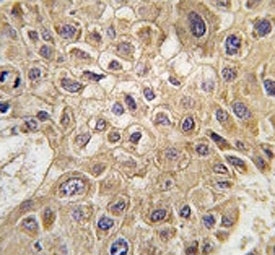 IHC analysis of FFPE human hepatocarcinoma tissue stained with AMFR antibody