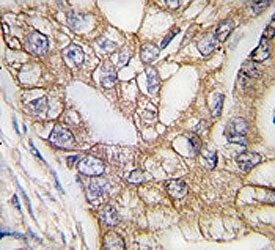 IHC analysis of FFPE human lung carcinoma tissue stained with Ihh antibody~