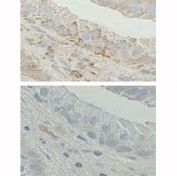 IHC analysis of FFPE human prostate tissue. (Top) Staining with the ERAB antibody at a 1:20 concentration. (Bottom) Staining is blocked wtih the immunizing peptide. Data and protocol courtesy of Marie-Helene Levesque, Centre de Recherche du CHUL, Canada.