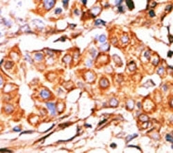 IHC analysis of FFPE human breast carcinoma stained with the Glycerol kinase 2 antibody