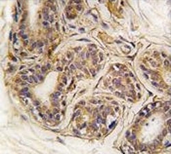 IHC analysis of FFPE human breast carcinoma tissue stained with CASC3 antibody~