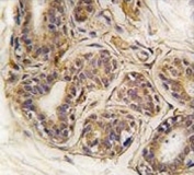 IHC analysis of FFPE human breast carcinoma tissue stained with CASC3 antibody
