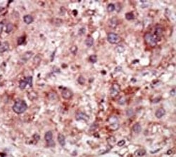IHC analysis of FFPE human hepatocarcinoma stained with the GAK antibody~